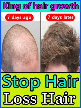 Rychlý růst vlasů sérum pro léčbu alopecie, seboroická alopecie, dědičné alopecie, atd.